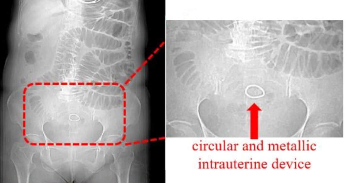 «Забытый» внутриматочный контрацептив едва не убил женщину через полвека после установки