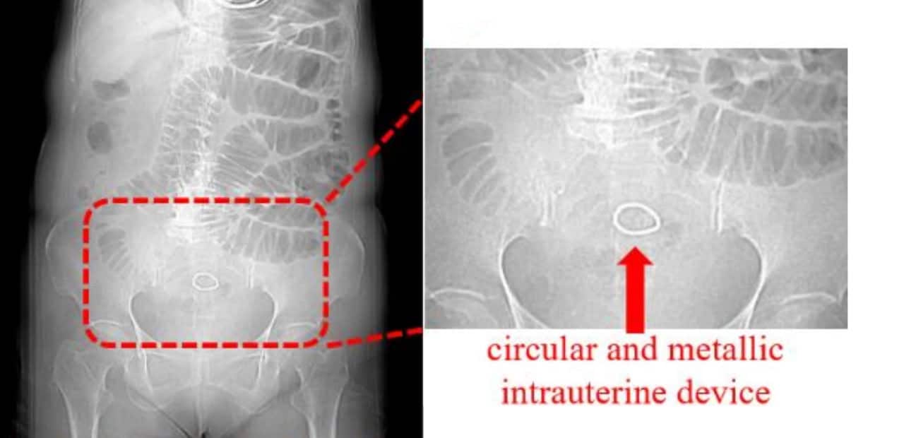 «Забытый» внутриматочный контрацептив едва не убил женщину через полвека после установки