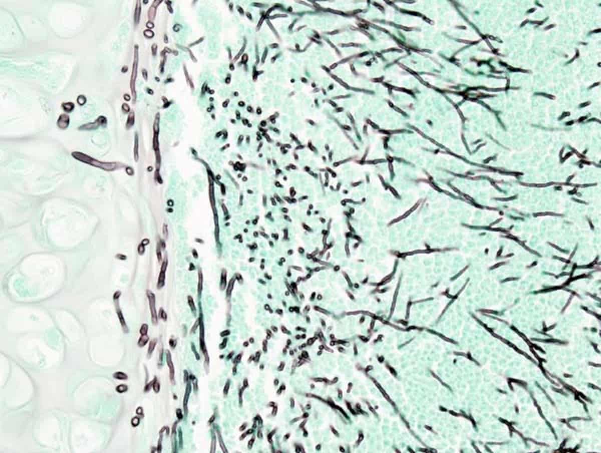 Инфекция, вызванная плесневым грибком Aspergillus в легких пациента  / © wikipedia