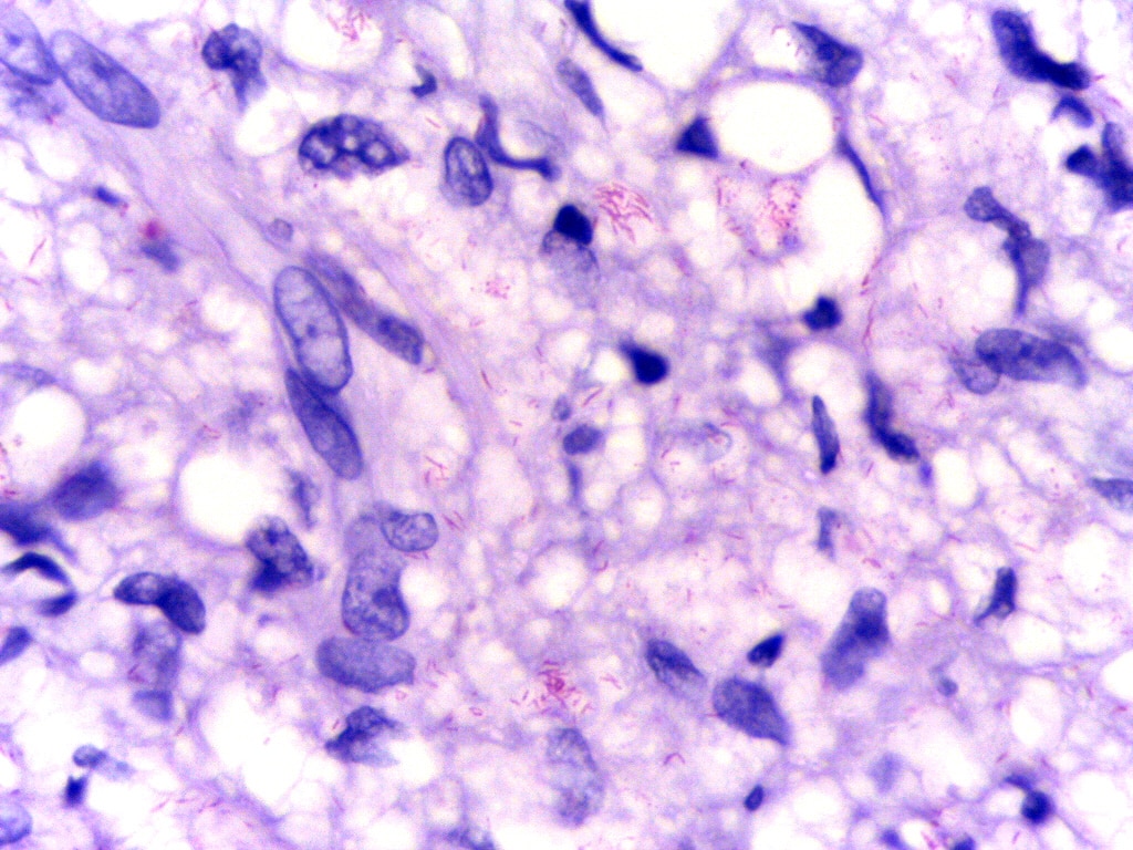 Mycobacterium leprae
