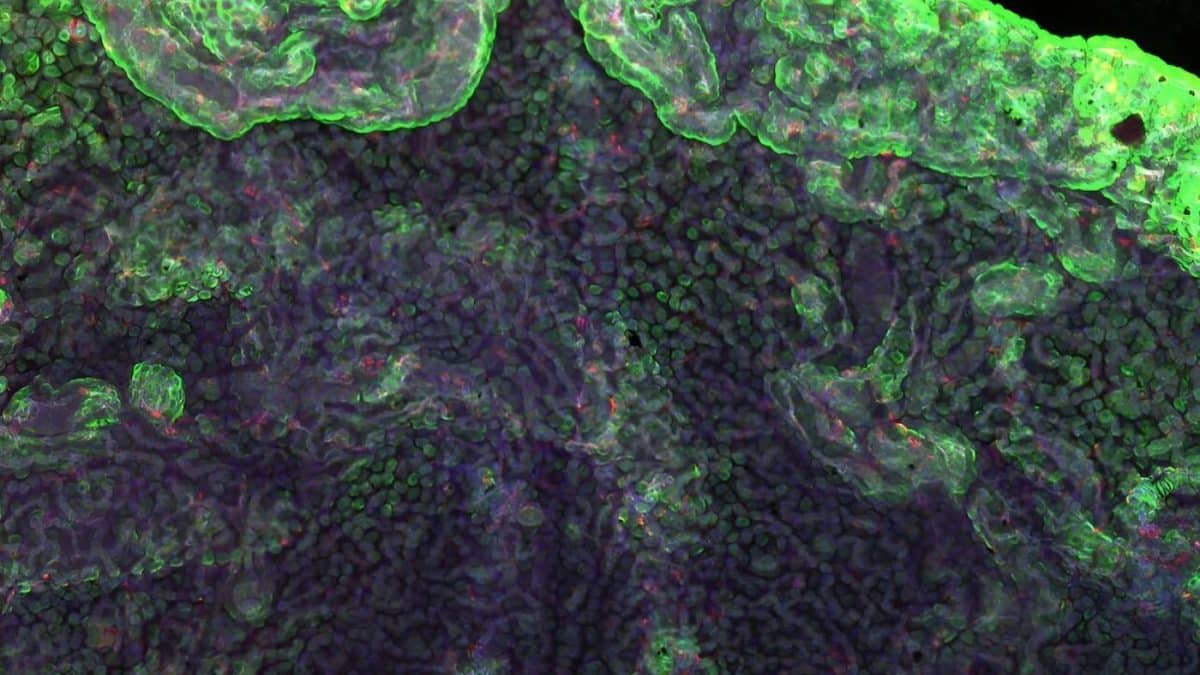 Вирус гепатита С обнаружен в мозге при шизофрении и биполярном расстройстве