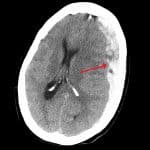 Цифровой помощник помог оценить перспективы восстановления после черепно-мозговой травмы