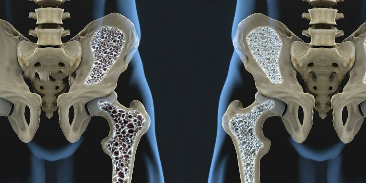 Иллюстрация костей при остеопорозе и в норме / © Javier Regueiro, shutterstock
