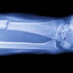 Ученые определили, какая структура имплантата помогает кости восстанавливаться быстрее