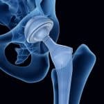 Ученые научились рассчитывать «старение» углеродных протезов суставов