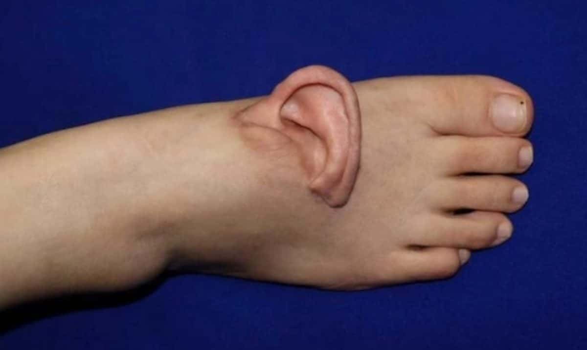 Китаянке пересадили ухо на стопу / © SINA