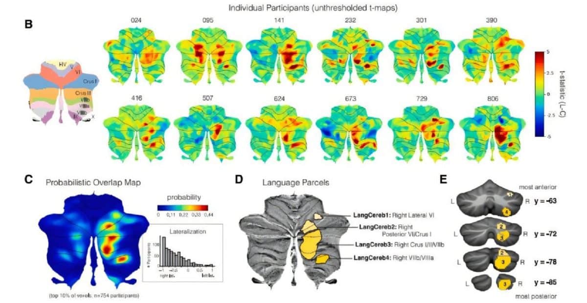 16 лет наблюдений заставили переосмыслить роль мозжечка в обработке речи