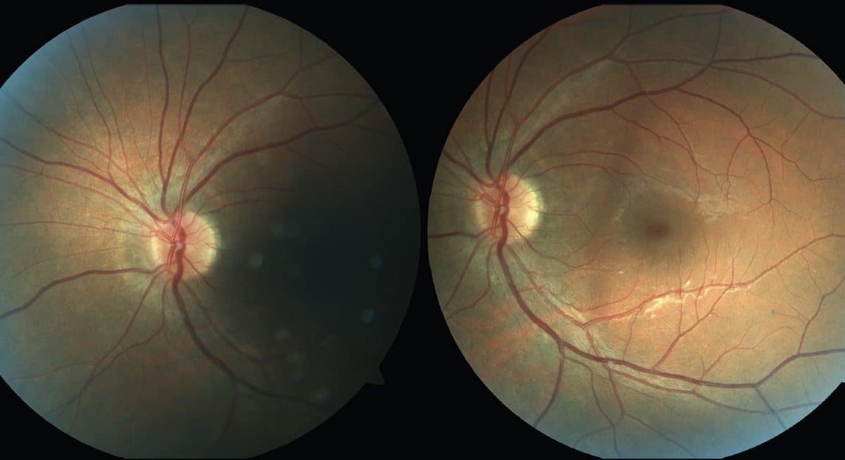 Ученые предложили столкнуть три теории сознания в эксперименте со слепым пятном глаза