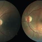 Ученые предложили столкнуть три теории сознания в эксперименте со слепым пятном глаза