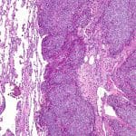 В России предложили новый подход к лечению саркомы Юинга, устойчивой к химиотерапии