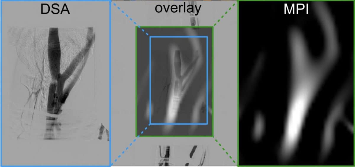 Магнитно-частичную томографию впервые опробовали на человеке