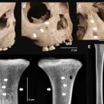 Археологи обнаружили древнейшие случаи врожденного сифилиса во Вьетнаме