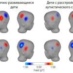 Нарушение речи при аутизме связали с нетипичной активностью слуховой коры