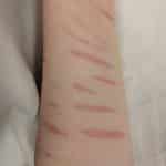 Терапия самоповреждений оказалась менее эффективной для мужчин